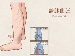 静脉曲张培训班怎么报名